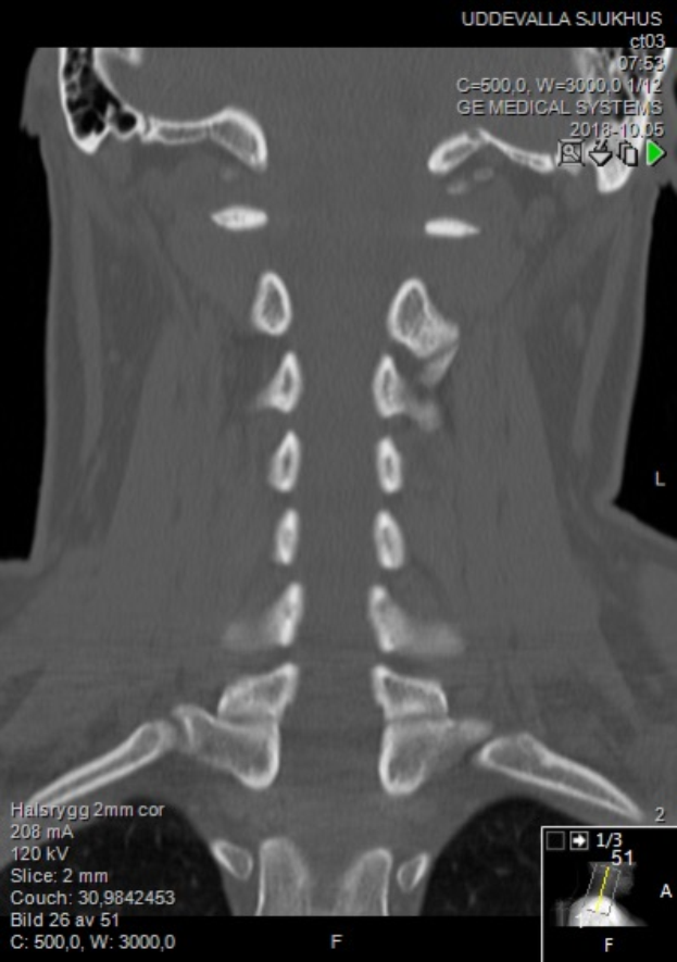 Ein MRI-Bild eines Mannes mit einem Halsbruch, das auf einem Computerbildschirm angezeigt wird, zeigt die Größe, Form und Lage des Bruchs.